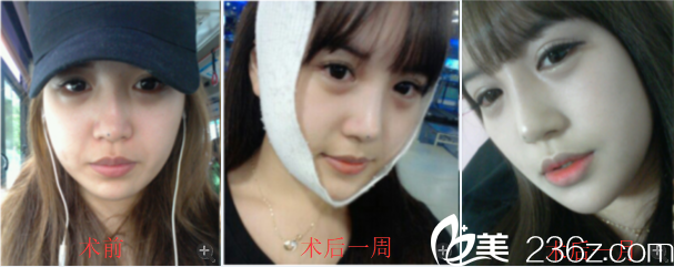 韓國(guó)優(yōu)尼克整形李世彬院長(zhǎng)V臉案例 韓國(guó)優(yōu)尼克整形李世彬院長(zhǎng)V臉案例