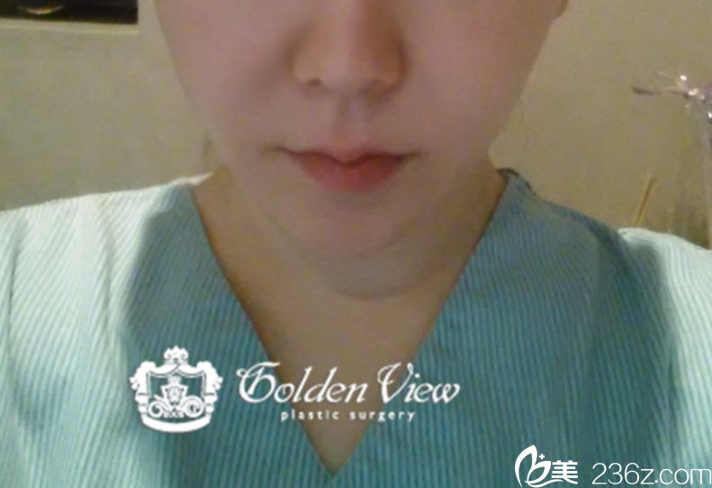韓國金薇整形整形外科醫(yī)院找宋尚勛院長做的嘴角上揚(yáng)
