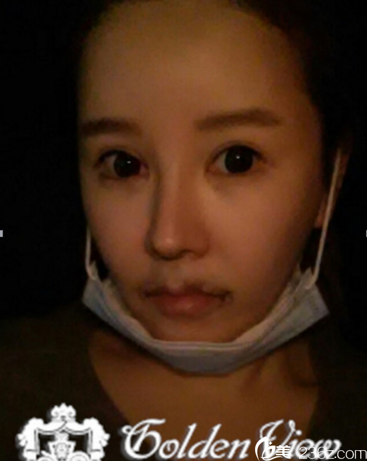 宋尚勛院長做的嘴角上揚(yáng)真人案例