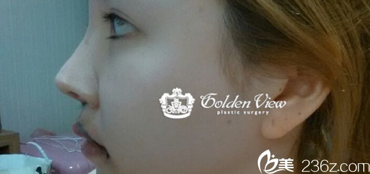 金薇人中縮小真人案例