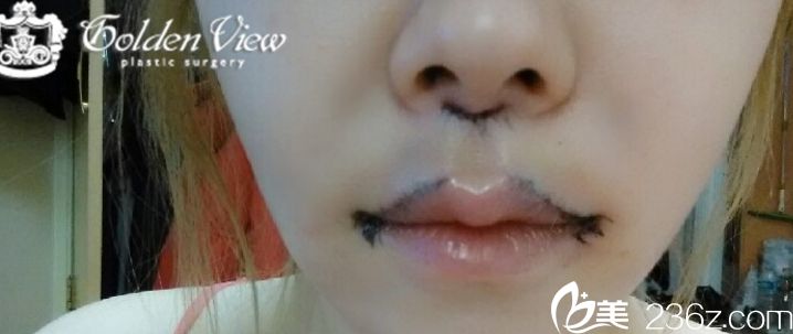 金薇人中縮小手術(shù)怎么樣