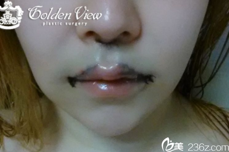 宋尚勛金薇人中縮小出名嗎