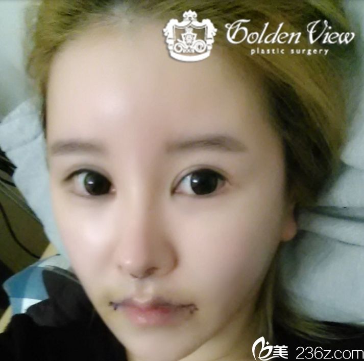 嘴角上揚(yáng)+金薇人中縮小+真皮移植案例