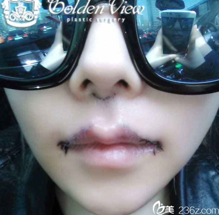 韓國金薇整形整形外科做口唇整形怎么樣