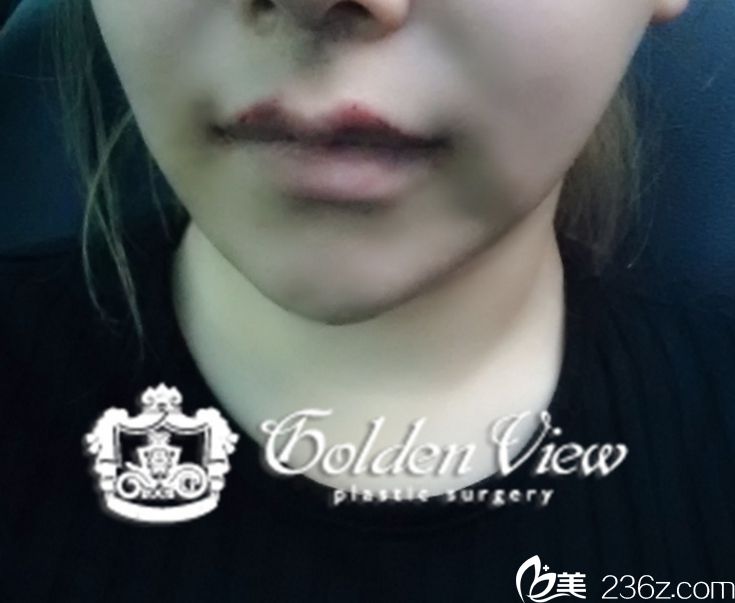 韓國金薇人中縮小手術(shù)價(jià)格