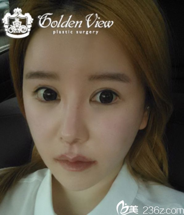 分享我在韓國金薇整形外科找宋尚勛院長做的嘴角上揚+人中縮小+真皮移植案例