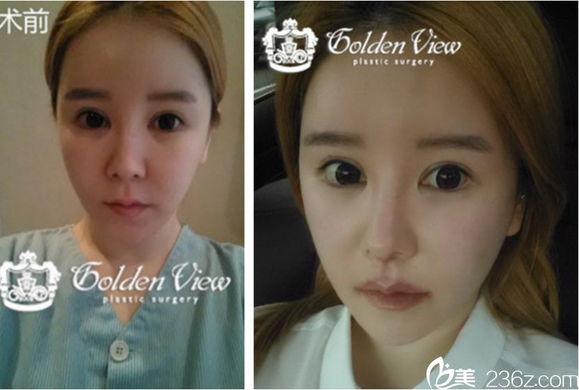 韓國口唇整形醫(yī)院哪家好？金薇整形外科醫(yī)院