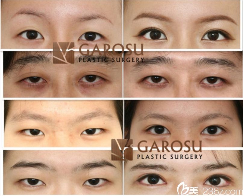 樸章佑做眼部整的精彩案例