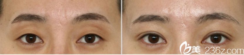 凱倫秀整形外科做眼部整形怎么樣