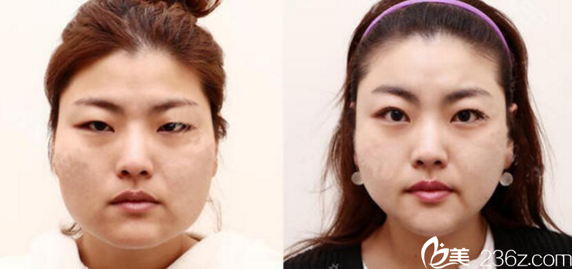 凱倫秀 非切開埋線提肌+顴骨+V臉+臉部吸脂真人案例