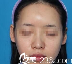 崔鐘武院長膨體隆鼻真人案例手術(shù)前 崔鐘武院長膨體隆鼻真人案例手術(shù)前