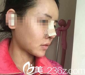 崔鐘武院長膨體隆鼻剛做完手術(shù)當(dāng)天 崔鐘武院長膨體隆鼻剛做完手術(shù)當(dāng)天