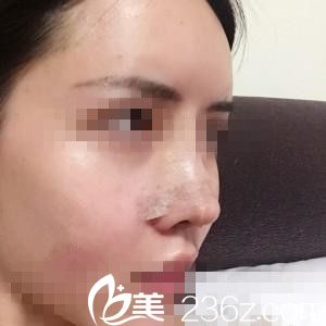 崔鐘武院長膨體隆鼻三天后 崔鐘武院長膨體隆鼻三天后