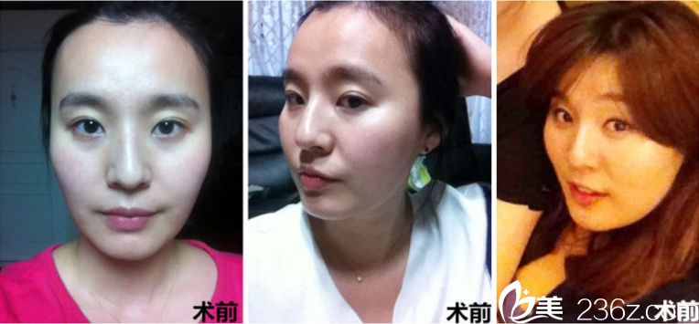 韓國(guó)那家醫(yī)院做輪廓手術(shù)好 韓國(guó)那家醫(yī)院做輪廓手術(shù)好