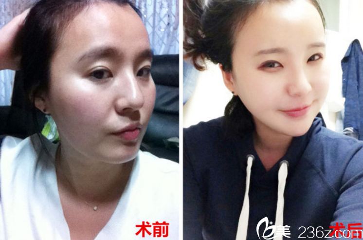 韓國(guó)拉菲安鄭宰永院長(zhǎng)顴骨縮小真人案例