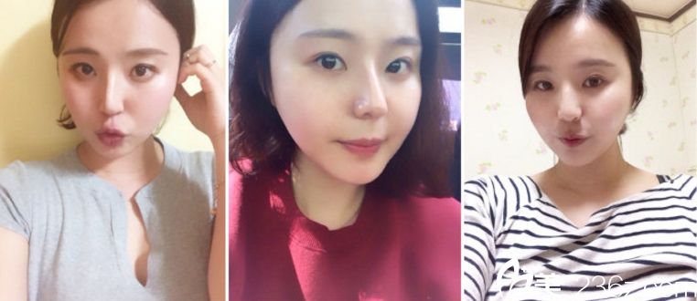 鄭宰永 院長(zhǎng)vline手術(shù)真人案例 鄭宰永 院長(zhǎng)vline手術(shù)真人案例