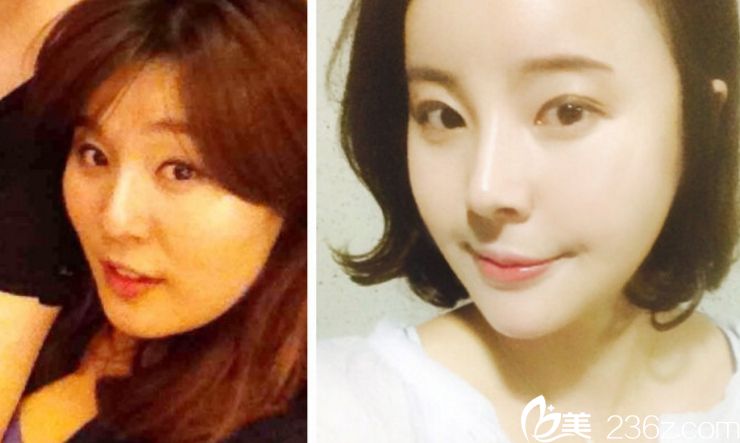 韓國(guó)拉菲安鄭宰永院長(zhǎng)做輪廓手術(shù)真人案例 韓國(guó)拉菲安鄭宰永院長(zhǎng)做輪廓手術(shù)真人案例