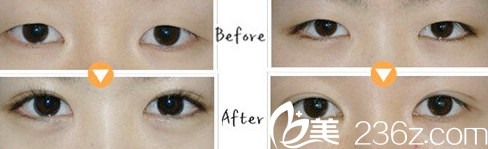 段春巍醫(yī)生雙眼皮案例 段春巍醫(yī)生雙眼皮案例