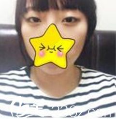 廈門歐菲雙眼皮整形前 廈門歐菲雙眼皮整形前