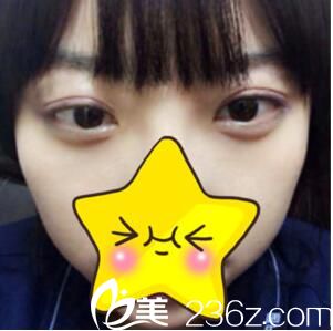 歐菲苗建國埋線雙眼皮初步效果 歐菲苗建國埋線雙眼皮初步效果