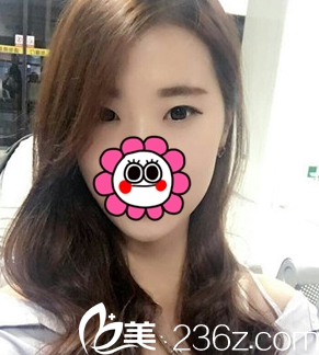 重慶藝星整形雙眼皮案例術(shù)前 重慶藝星整形雙眼皮案例術(shù)前