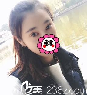 重慶藝星雙眼皮整形術(shù)后7天效果 重慶藝星雙眼皮整形術(shù)后7天效果