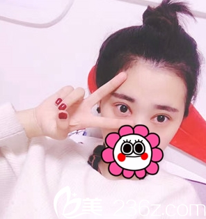 重慶藝星整形雙眼皮術(shù)后1個(gè)月 重慶藝星整形雙眼皮術(shù)后1個(gè)月