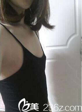 梁潔院長記錄求美者豐胸前