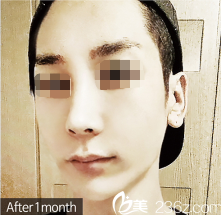 優(yōu)尼克整形李焌赫男士整形真人術(shù)后1個(gè)月 優(yōu)尼克整形李焌赫男士整形真人術(shù)后1個(gè)月