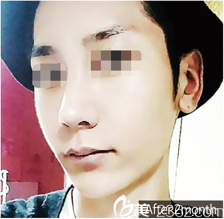 優(yōu)尼克整形李焌赫男士面部整形 優(yōu)尼克整形李焌赫男士面部整形