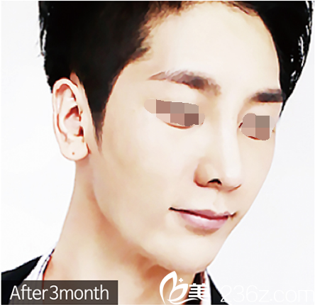 優(yōu)尼克整形金焌赫鼻修復(fù)術(shù)后3個(gè)月 優(yōu)尼克整形金焌赫鼻修復(fù)術(shù)后3個(gè)月