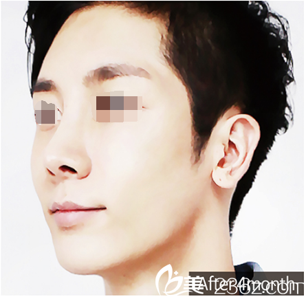 韓國優(yōu)尼克鼻整形面部輪廓加自體脂肪真人整形案例，男士變美也能改變命運