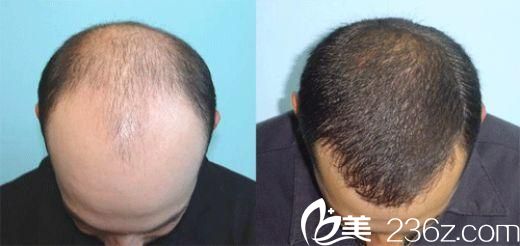 韓國狎鷗亭延世醫(yī)院毛發(fā)移植 韓國狎鷗亭延世醫(yī)院毛發(fā)移植