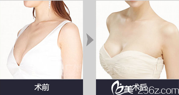 南充韓美整形自體脂肪豐胸案例 南充韓美整形自體脂肪豐胸案例