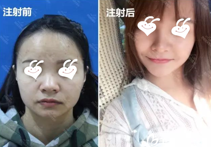 錢(qián)剛注射玻尿酸豐下巴效果 錢(qián)剛注射玻尿酸豐下巴效果