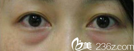 眼袋如今不只是上年齡的人才有