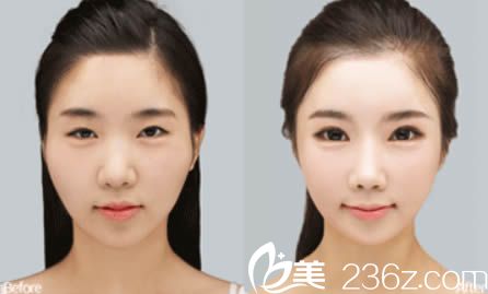 韓美陳誠面部綜合整形效果圖示