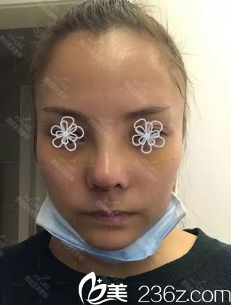 術(shù)后第九天了