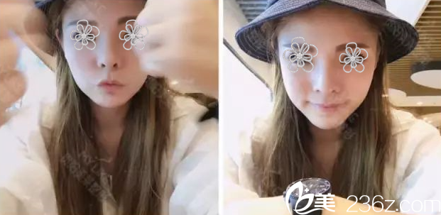 術(shù)后34天了，心情很棒！