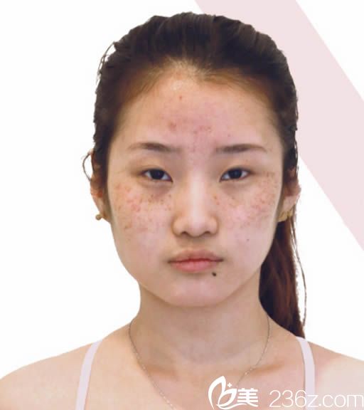 蘭州韓美整形祛斑前圖片 蘭州韓美整形祛斑前圖片