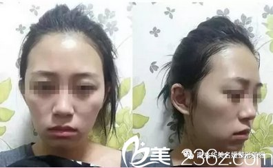 自體脂肪去除黑眼圈+脂肪填充全面部術(shù)前照 自體脂肪去除黑眼圈+脂肪填充全面部術(shù)前照