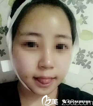 南充華美自體脂肪填充全面部術(shù)后5天 南充華美自體脂肪填充全面部術(shù)后5天