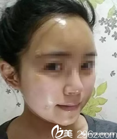 南充華美自體脂肪去除黑眼圈術(shù)后8天 南充華美自體脂肪去除黑眼圈術(shù)后8天