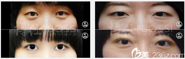 廣州博仕李帥敏內(nèi)眥贅皮雙眼皮案例 廣州博仕李帥敏內(nèi)眥贅皮雙眼皮案例