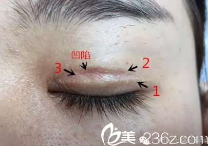 失敗雙眼皮閉眼效果