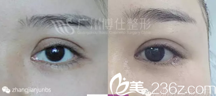 雙眼皮術(shù)后即刻效果對(duì)比