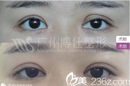 雙眼皮失敗3次，這次找廣州博仕整形醫(yī)院張建軍終于修復(fù)成功了