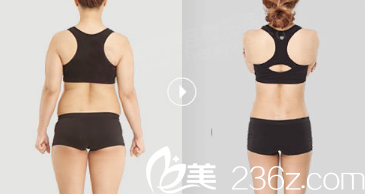 紫潔儷方（北京）醫(yī)療美容診所劉文鋒醫(yī)生吸脂案例