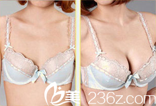 紫潔儷方（北京）醫(yī)療美容診所劉文鋒醫(yī)生自體脂肪豐胸案例