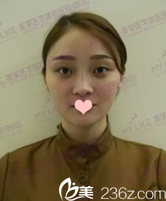 鼻修復(fù)術(shù)前照片 鼻修復(fù)術(shù)前照片